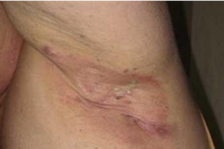 hidradenitis suppurativa - Diagnosis