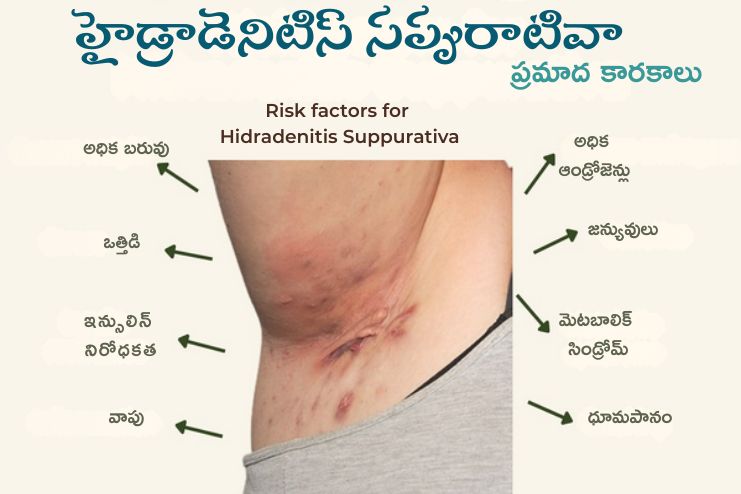 hidradenitis suppurativa - Risk factors