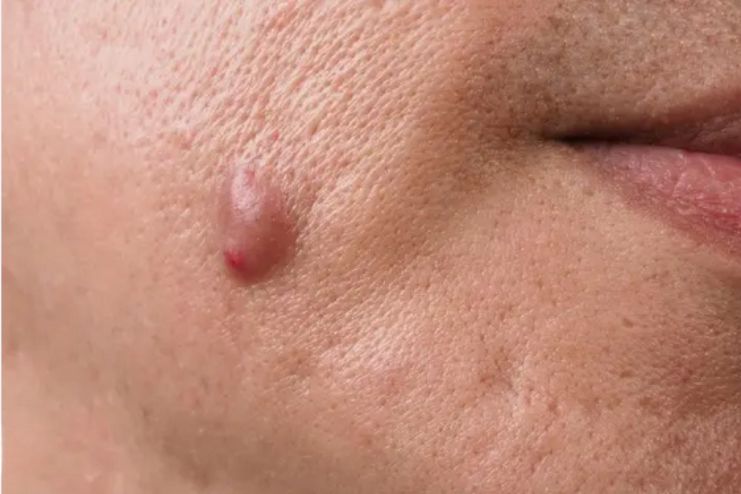 hidradenitis suppurativa symptoms