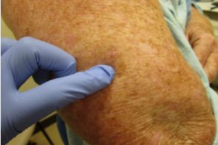 treatment for actinic keratosis