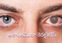 అకాంతమీబా కెరటైటిస్: కారణాలు, లక్షణాలు, చికిత్స Acanthamoeba keratitis_ Symptoms, Causes, and Treatment