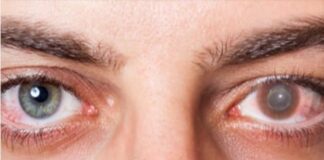 అకాంతమీబా కెరటైటిస్: కారణాలు, లక్షణాలు, చికిత్స - Acanthamoeba keratitis: Symptoms, Causes, and Treatment Acanthamoeba keratitis_ Symptoms, Causes, and Treatment