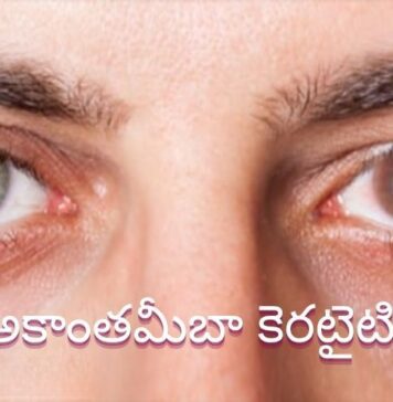 అకాంతమీబా కెరటైటిస్: కారణాలు, లక్షణాలు, చికిత్స Acanthamoeba keratitis_ Symptoms, Causes, and Treatment