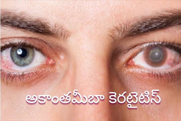 అకాంతమీబా కెరటైటిస్: కారణాలు, లక్షణాలు, చికిత్స - <span class='sndtitle'></img>Acanthamoeba keratitis: Symptoms, Causes, and Treatment </span>
