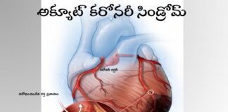 అక్యూట్ కరోనరీ సిండ్రోమ్: లక్షణాలు మరియు చికిత్స - Acute coronary syndrome: Symptoms and Treatment Acute coronary syndrome_ Symptoms and Treatment
