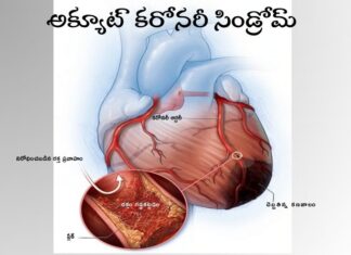 అక్యూట్ కరోనరీ సిండ్రోమ్: లక్షణాలు మరియు చికిత్స Acute coronary syndrome_ Symptoms and Treatment