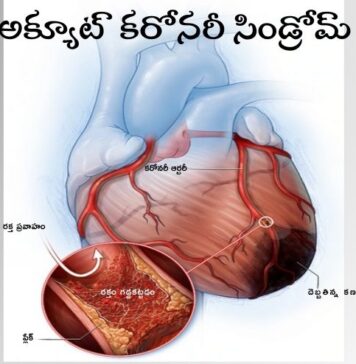 అక్యూట్ కరోనరీ సిండ్రోమ్: లక్షణాలు మరియు చికిత్స Acute coronary syndrome_ Symptoms and Treatment
