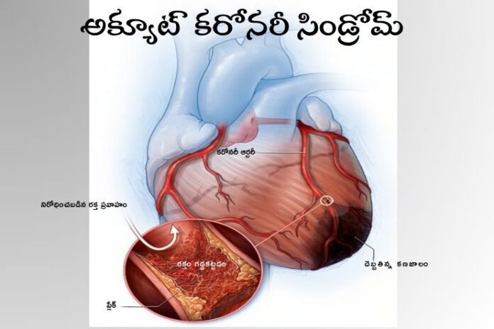 Acute coronary syndrome_ Symptoms and Treatment