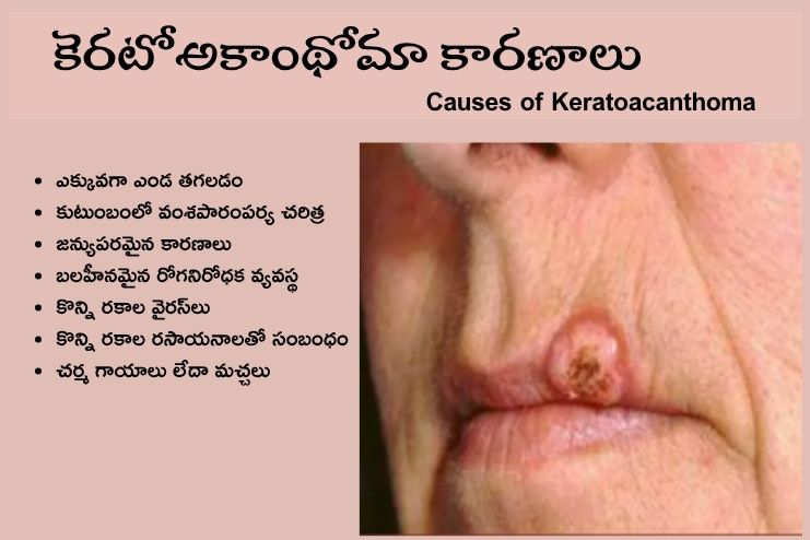 Causes of Keratoacanthoma