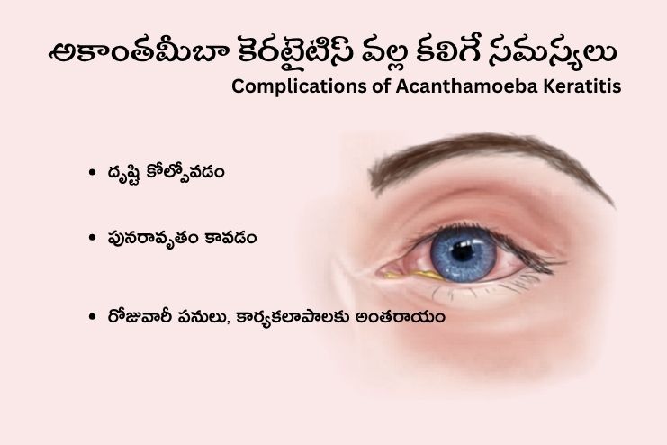 Complications of Acanthamoeba Keratitis