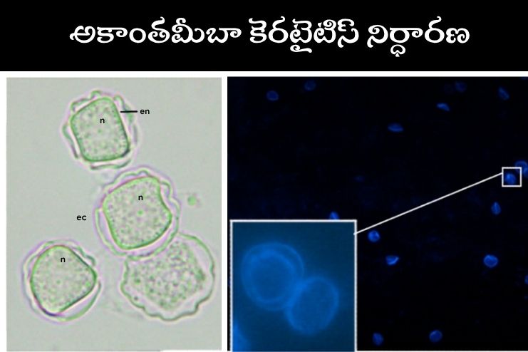 Diagnosis of Acanthamoeba Keratitis