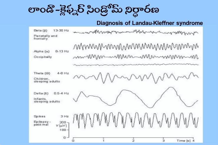 Diagnosis of Landau-Kleffner syndrome