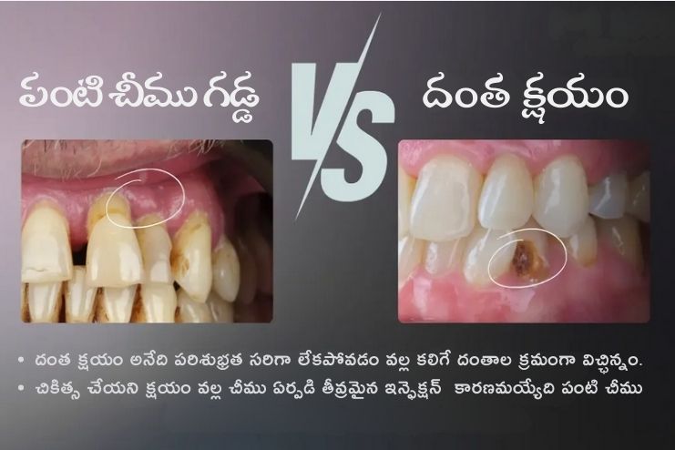 Difference between infected and abscessed tooth