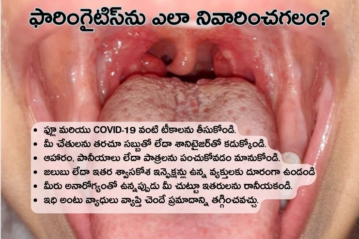 How can I prevent a pharyngitis