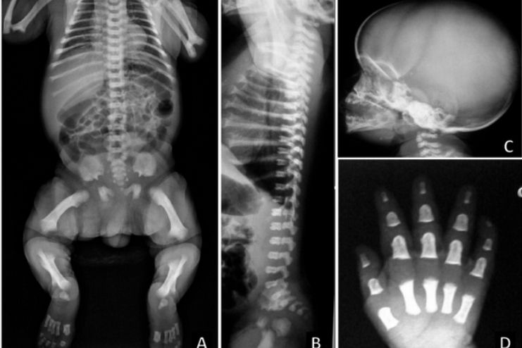 How is achondroplasia diagnosed
