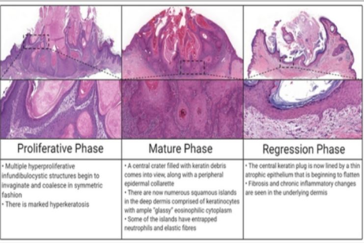 Keratoacanthoma stages
