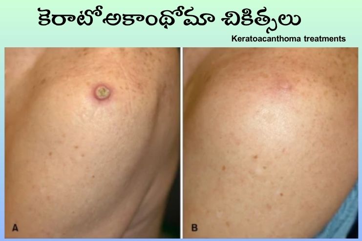 Keratoacanthoma treatments