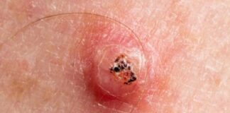 కెరటోఅకాంథోమా: కారణాలు,లక్షణాలు, మరియు చికిత్స - Keratoacanthoma: Symptoms, Causes, and Treatments Keratoacanthoma_ Symptoms, Causes, and Treatments