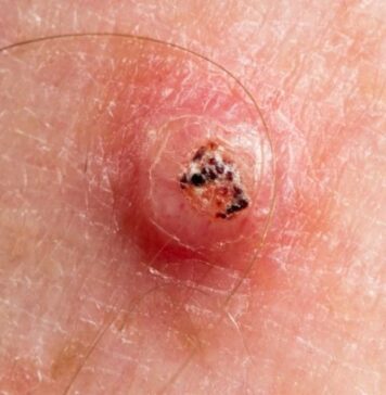 కెరటోఅకాంథోమా: కారణాలు,లక్షణాలు, మరియు చికిత్స Keratoacanthoma_ Symptoms, Causes, and Treatments