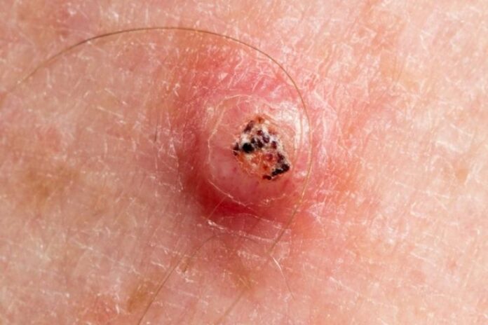 Keratoacanthoma_ Symptoms, Causes, and Treatments