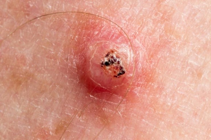 కెరటోఅకాంథోమా: కారణాలు,లక్షణాలు, మరియు చికిత్స - <span class='sndtitle'></img>Keratoacanthoma: Symptoms, Causes, and Treatments </span>