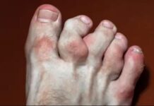 మాఫుచీ సిండ్రోమ్: కారణాలు, లక్షణాలు, చికిత్స Maffucci syndrome_ Causes, Symptoms and Treatment