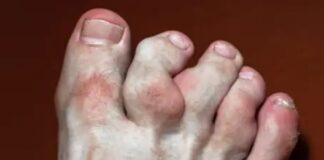 మాఫుచీ సిండ్రోమ్: కారణాలు, లక్షణాలు, చికిత్స - Maffucci Syndrome- Symptoms, Causes, and Treatment Maffucci syndrome_ Causes, Symptoms and Treatment