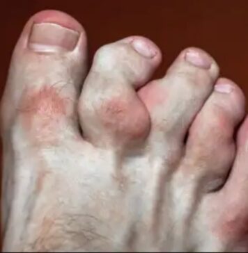 మాఫుచీ సిండ్రోమ్: కారణాలు, లక్షణాలు, చికిత్స Maffucci syndrome_ Causes, Symptoms and Treatment