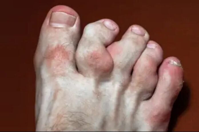 Maffucci syndrome_ Causes, Symptoms and Treatment