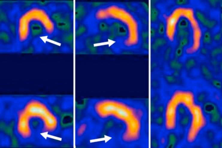 Myocardial perfusion imaging