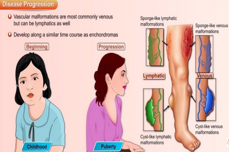 Outlook of Maffucci syndrome