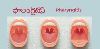 ఫారింగైటిస్ అంటే ఏమిటి?: కారణాలు, చికిత్స, నివారణ - Pharyngitis: Causes, Treatment and Prevention Pharyngitis_ Causes, Treatment and Prevention