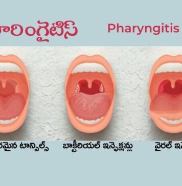 ఫారింగైటిస్ అంటే ఏమిటి?: కారణాలు, చికిత్స, నివారణ Pharyngitis_ Causes, Treatment and Prevention