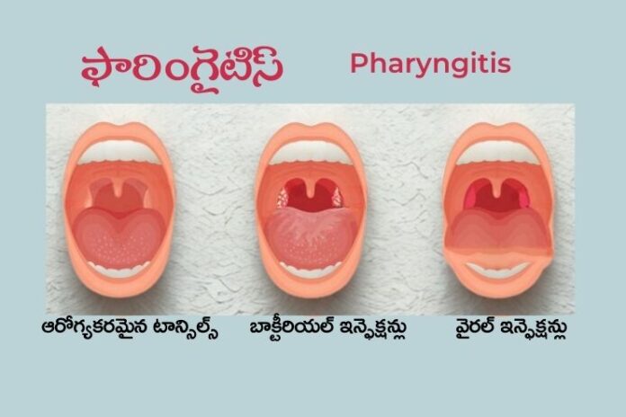 Pharyngitis_ Causes, Treatment and Prevention