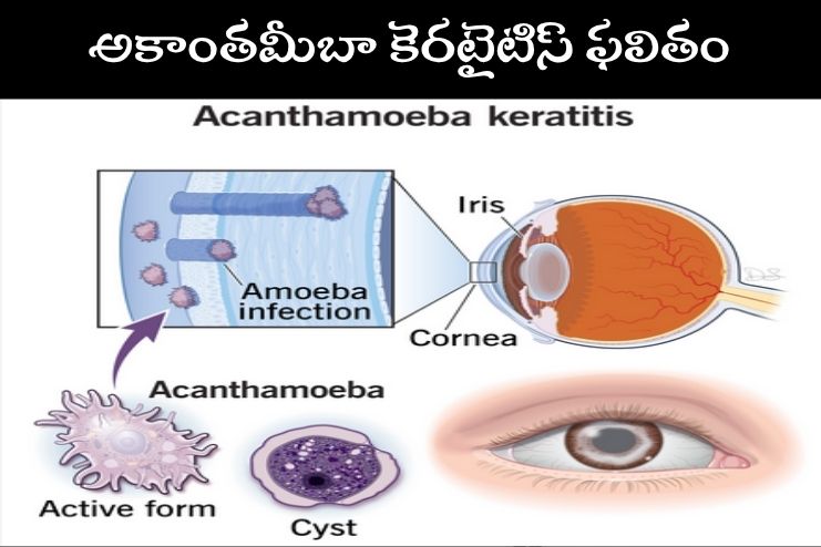 Prognosis of Acanthamoeba Keratitis