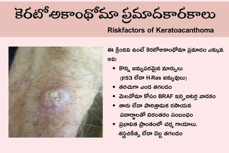 Riskfactors of Keratoacanthoma