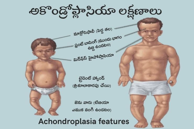 Symptoms of Achondroplasia