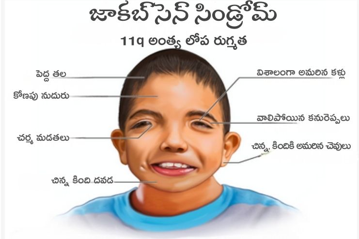 Symptoms of Jacobsen syndrome