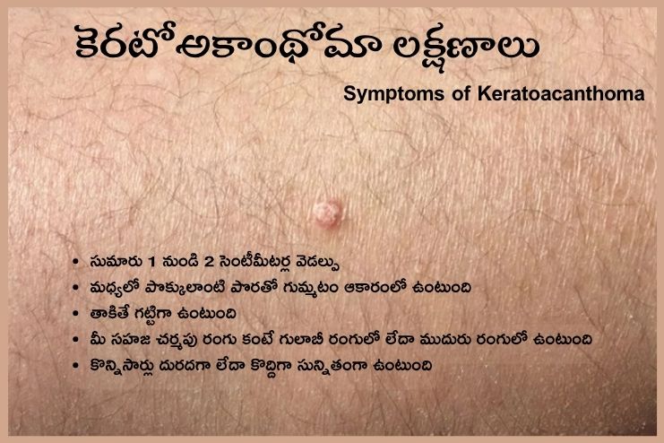 Symptoms of Keratoacanthoma