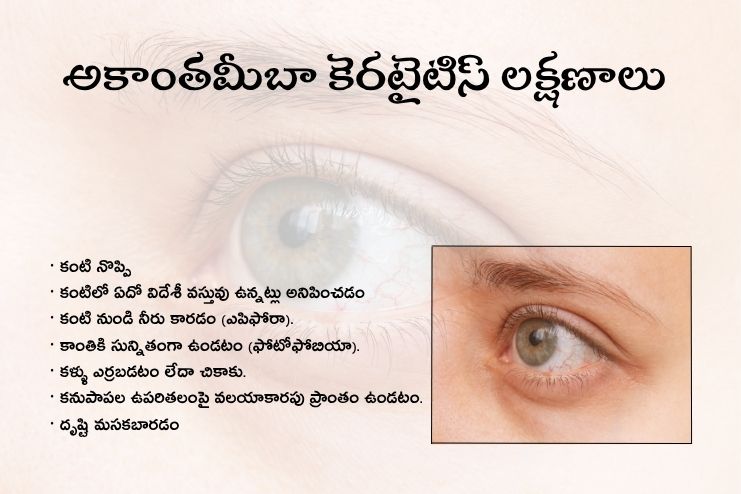 Symptoms of acanthamoeba keratitis