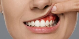 పంటి చీము గడ్డ: కారకాలు, లక్షణాలు మరియు చికిత్స - Tooth Abscess: Causes, Symptoms and Treatment Tooth Abscess_ Causes, Symptoms and Treatment