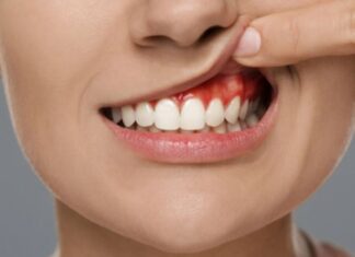 పంటి చీము గడ్డ: కారకాలు, లక్షణాలు మరియు చికిత్స Tooth Abscess_ Causes, Symptoms and Treatment