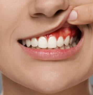 పంటి చీము గడ్డ: కారకాలు, లక్షణాలు మరియు చికిత్స Tooth Abscess_ Causes, Symptoms and Treatment