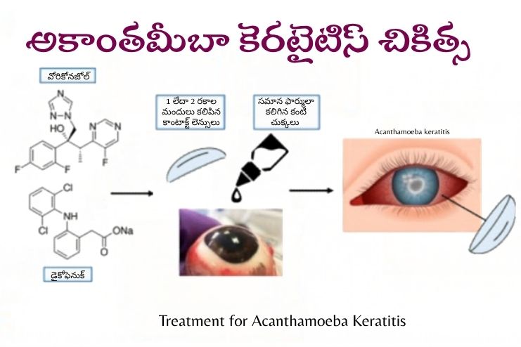 Treatment of Acanthamoeba Keratitis