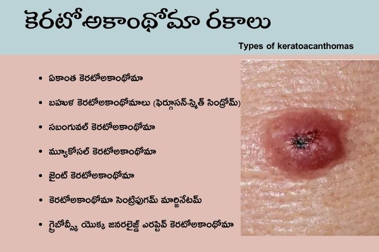 Types of keratoacanthomas