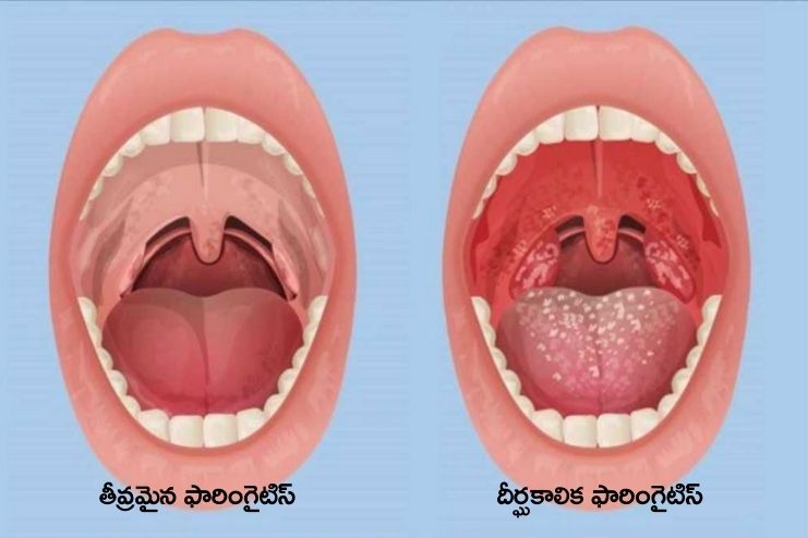 Types of pharyngitis