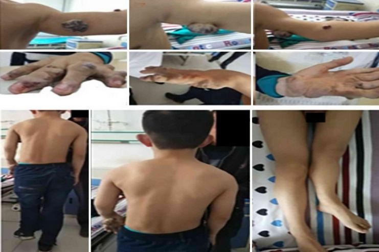 What Is Maffucci syndrome 2