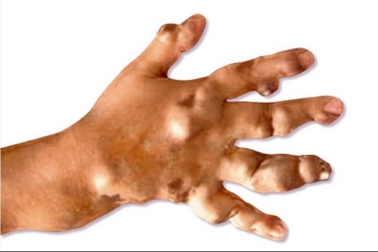 What Is Maffucci syndrome