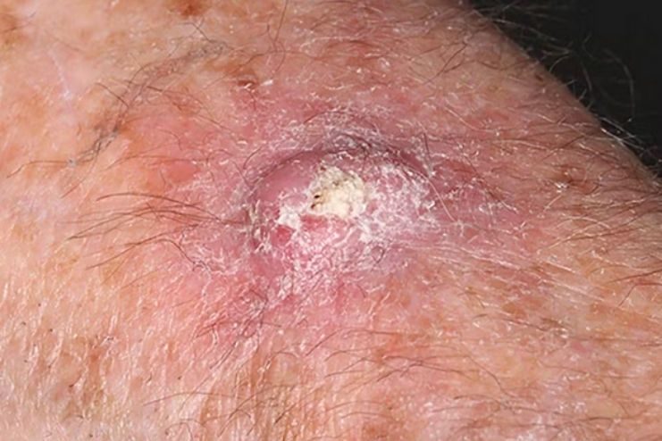 What Is a Keratoacanthoma