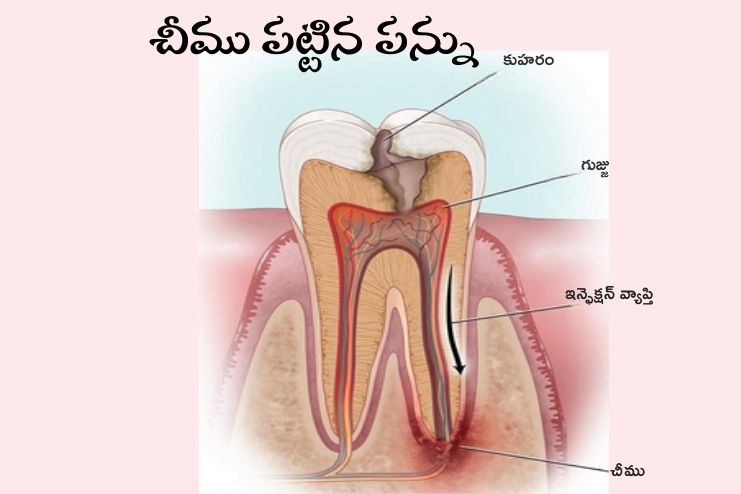 What Is a Tooth Abscess